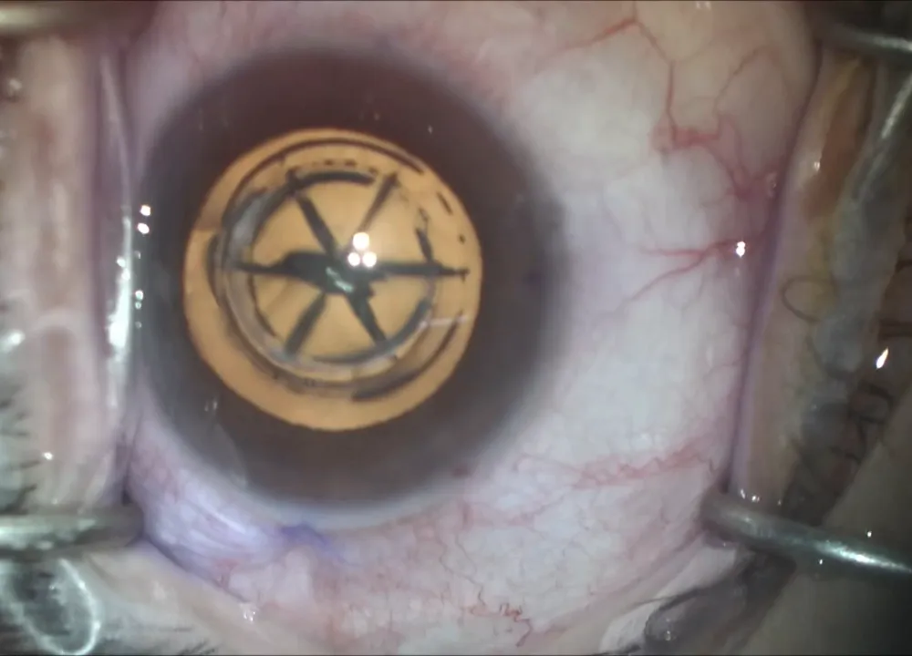 Laser-cut capsulotomy with the cataract already segmented by the laser