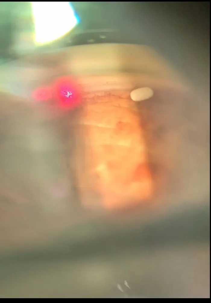 View through a gonioscopy lens during SLT laser, with the red aiming beam on the drainage angle